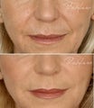 Restylane Nasolabial Folds Before After