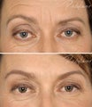 Before and after Restylane Perlane