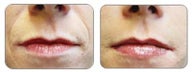 Before and after Restylane around mouth