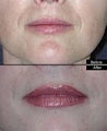 Lip Fillers