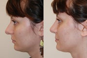 Revision Rhinoplasty