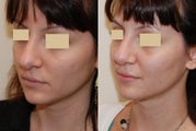 Revision Rhinoplasty