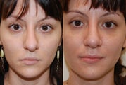 Revision Rhinoplasty