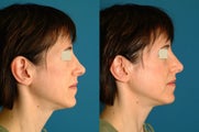 Non Surgical Rhinoplasty