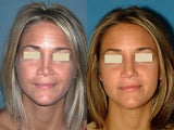 Revision Rhinoplasty