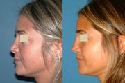 Revision Rhinoplasty