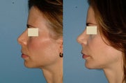 Rhinoplasty - Secondary