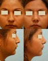 Revision/Corrective Rhinoplasty