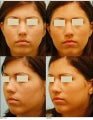 Revision/Corrective Rhinoplasty