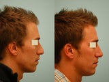 Revision/Corrective Rhinoplasty