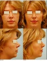 Revision/Corrective Rhinoplasty