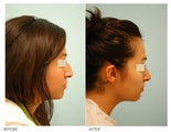 Revision/Corrective Rhinoplasty