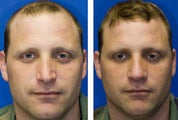 Revision Rhinoplasty