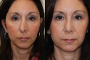 Revision Rhinoplasty. 1 month post-op.
