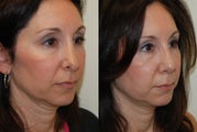 Revision Rhinoplasty. 1 month post-op.