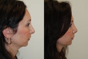 Revision Rhinoplasty. 1 month post-op.