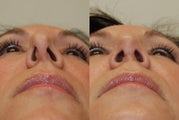 Revision Rhinoplasty. 1 month post-op.