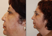 Revision Rhinoplasty, profile view