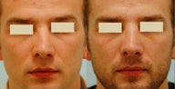 Revision/Corrective Rhinoplasty