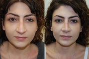 Revision Rhinoplasty. Early, 5-weeks post-op, front view