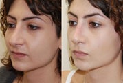Revision Rhinoplasty. Early, 5-weeks post-op. 3/4 view