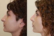 Revision Rhinoplasty. Early, 5-weeks post-op. Profile view.