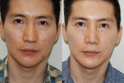 Revision Rhinoplasty and Chin Implant Surgery.