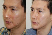 Revision Rhinoplasty and Chin Implant Surgery.