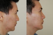 Revision Rhinoplasty and Chin Implant Surgery.