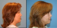 Revision Rhinoplasty