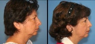 revision rhinoplasty