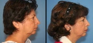 revision rhinoplasty