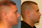 male rhinoplasty