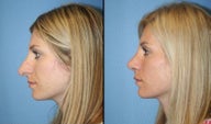Rhinoplasty