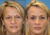revision rhinoplasty
