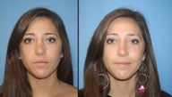 revision rhinoplasty