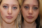 Revision Rhinoplasty. 1 month post-op.