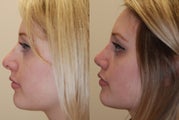 Revision Rhinoplasty. 1 month post-op.