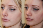 Revision Rhinoplasty. 1 month post-op.