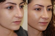 Revision Rhinoplasty Surgery. 1 year post-op.