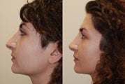 Revision Rhinoplasty Surgery. 1 year post-op.