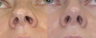 Revision Rhinoplasty