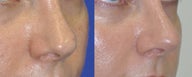 Revision Rhinoplasty