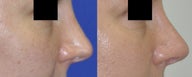 Revision Rhinoplasty