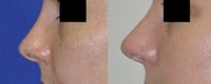 Revision Rhinoplasty