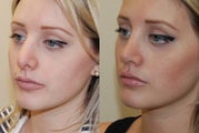 Revision Rhinoplasty Surgery. 6-months post-op.
