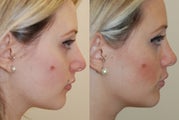 Revision Rhinoplasty Surgery. 6-months post-op.