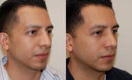 Rhinoplasty