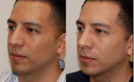 Rhinoplasty