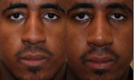 African-American Rhinoplasty